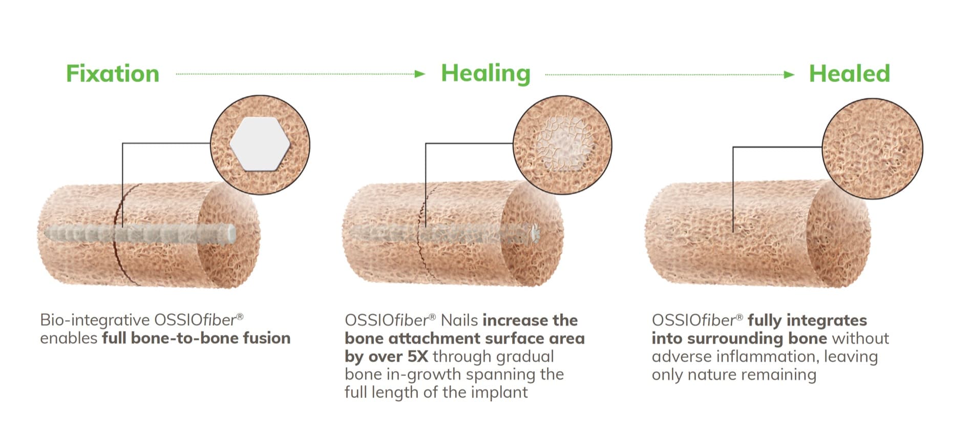 Three stages of bio-integration: fixation, healing, and a fully healed implant replaced by the patient's own bone