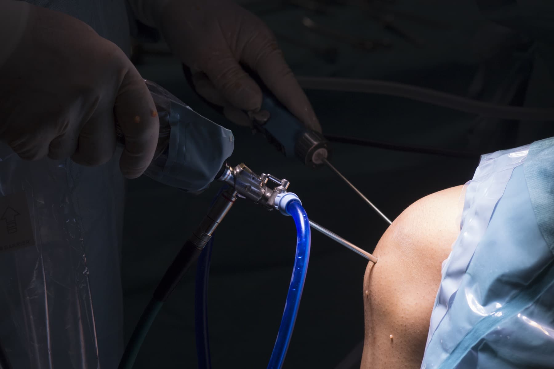 Minimally invasive arthroscopic knee surgery in progress